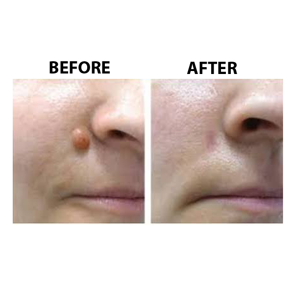 Skin Tags Removal Perpetual Beauty and Wellness