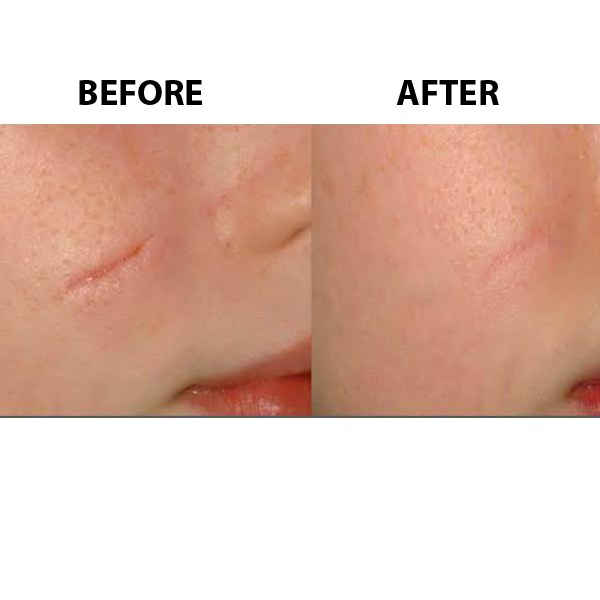 Scar Revision Perpetual Beauty and Wellness